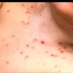 اجراءات وزاره الصحه والقلق من فيروس جدرى الماء