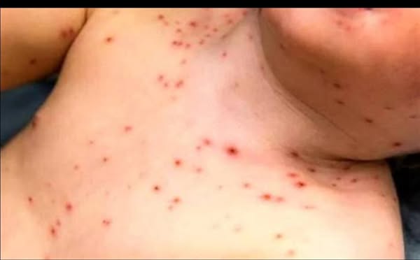 اجراءات وزاره الصحه والقلق من فيروس جدرى الماء