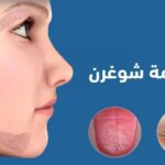 لمتلازمة شوغرن