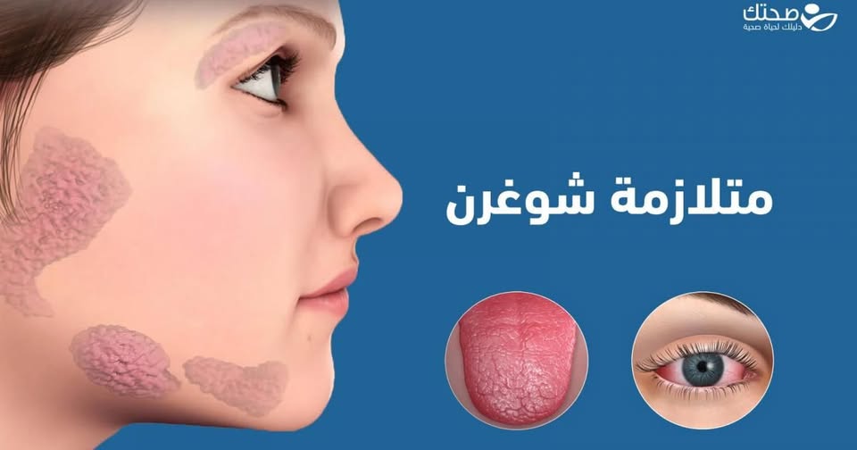 لمتلازمة شوغرن
