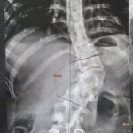 نجاح جراحة معقدة لتصحيح اعوجاج وتحدب العمود الفقري لفتاة بمستشفيات جامعة بنها