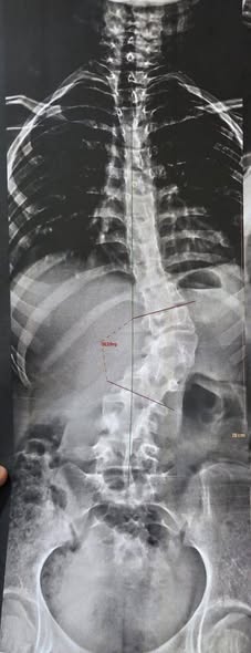 نجاح جراحة معقدة لتصحيح اعوجاج وتحدب العمود الفقري لفتاة بمستشفيات جامعة بنها